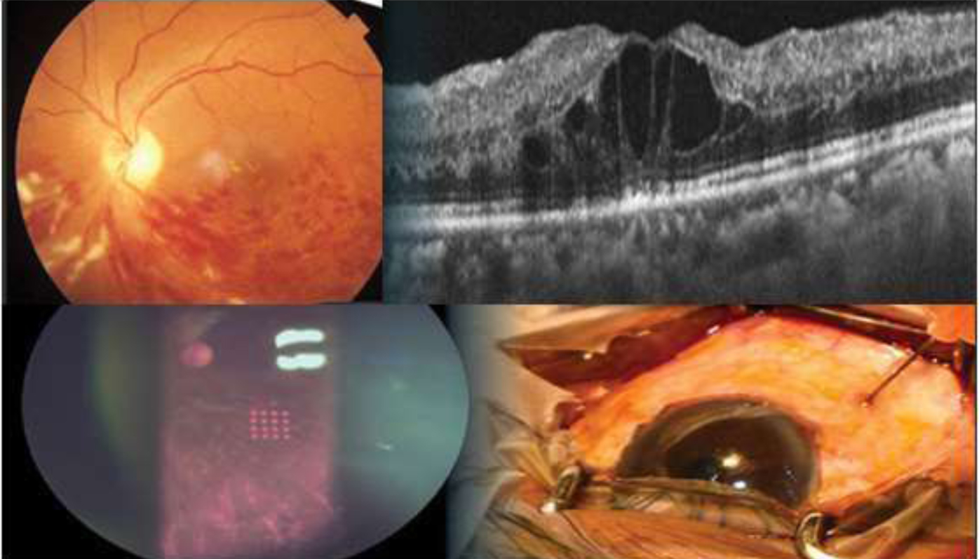 fellowship suvi eye