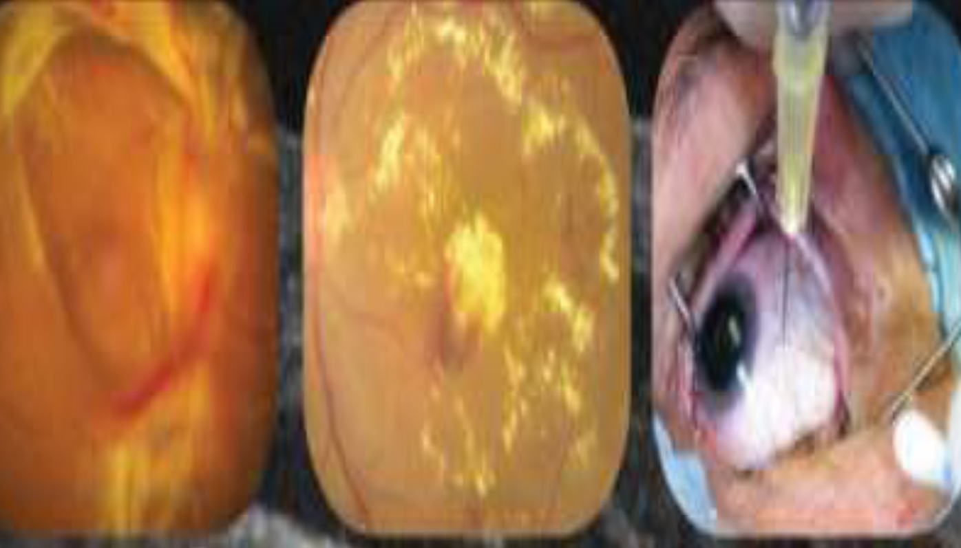 fellowship suvi eye